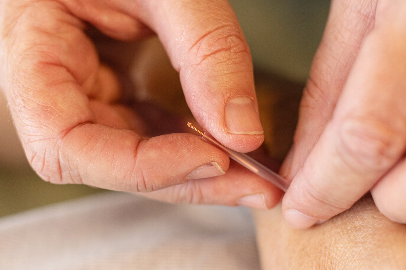 acupuncture